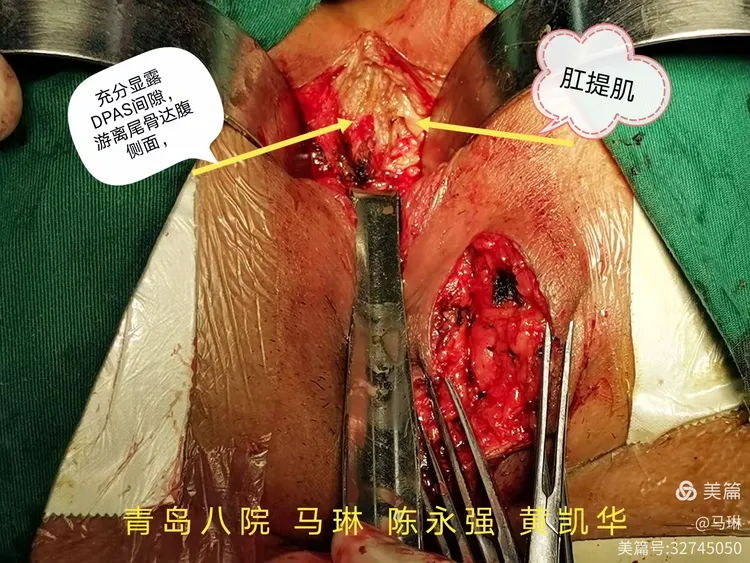 今日急诊完成一例高位复杂性肛周脓肿,祝愿病人早日康复🌻🌻🌷